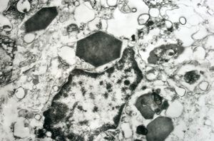 F,1y. | eosinophilic granuloma - Charcot- Leyden crystals F,1y. | eosinophilic granuloma - Charcot- Leyden crystals